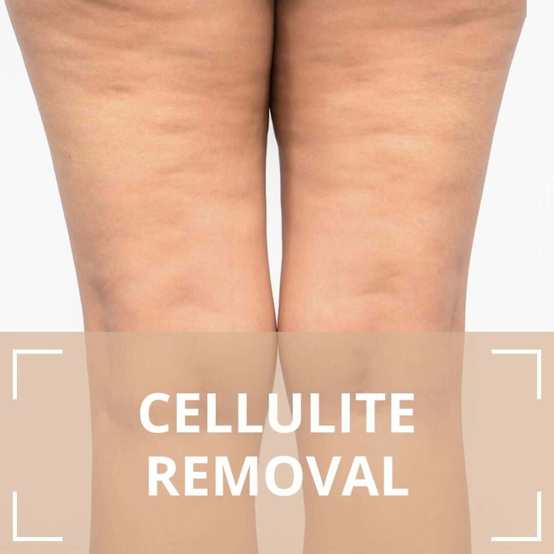 Collection 101 Pictures Images Of Cellulite On Legs Updated Collection 101 Pictures Images Of Cellulite On Legs Updated