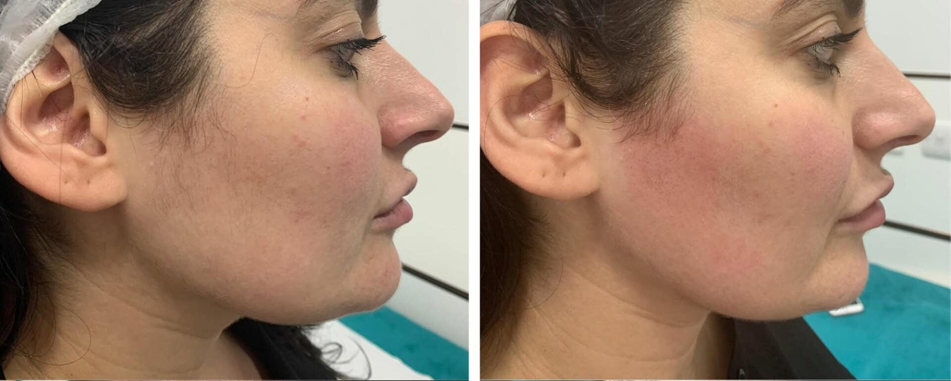 Laser Hair Removal Face Before And After Naked Grapefruit Laser Hair Removal Face Before And After Naked Grapefruit